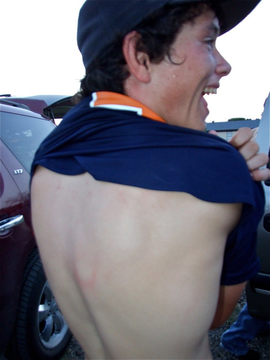 Image: Back pain — Teague’s Brandon Campbell shows off the mark on his back after being hit by the ball. Campbell hit a homerun against Clyde earlier in tournament play and finished with a double and a single against Corsicana on Saturday.